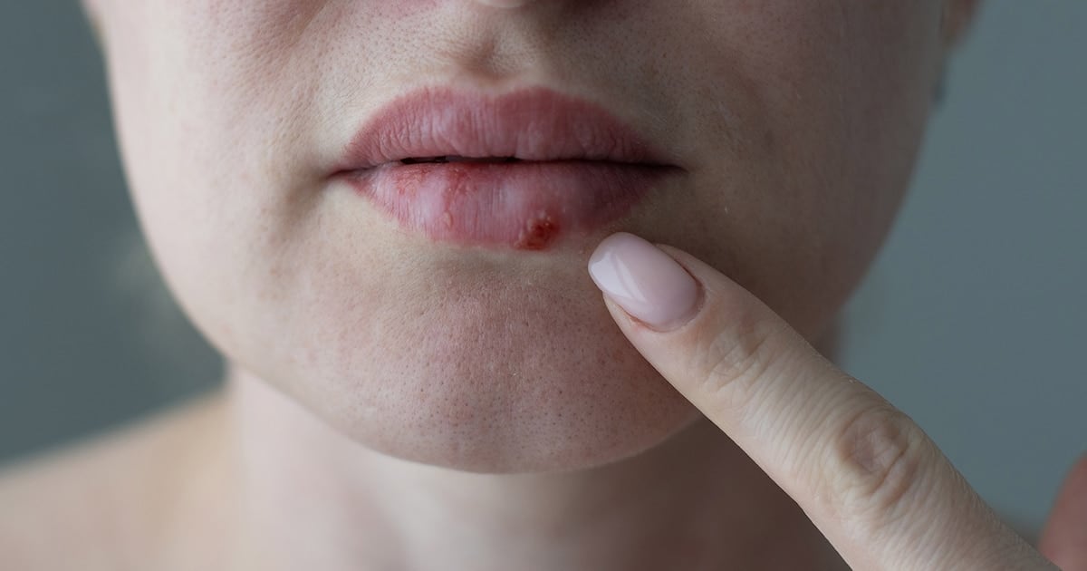 Después de casi 30 años, la FDA aprobó un antiviral oral que rompe la resistencia del herpes en pacientes con defensas bajas